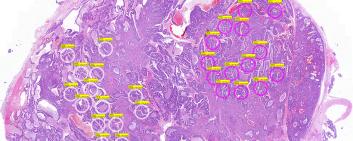 Métastase cérébrale du cancer de la prostate avec des zones intratumorales sélectionnées (cercles roses et blancs) en vue d'analyses moléculaires.